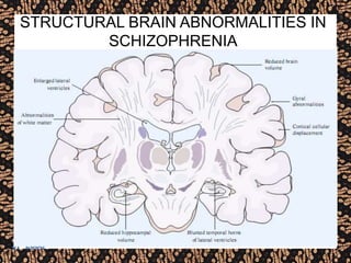 STRUCTURAL BRAIN ABNORMALITIES IN
SCHIZOPHRENIA
 