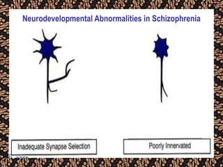 Neurodevelopmental Abnormalities in Schizophrenia
 