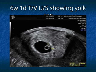 6w 1d T/V U/S showing yolk
6w 1d T/V U/S showing yolk
sac
sac
 
