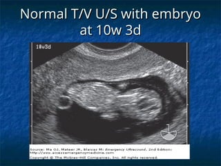 Normal T/V U/S with embryo
Normal T/V U/S with embryo
at 10w 3d
at 10w 3d
 