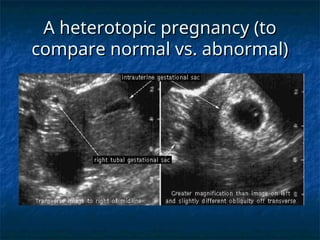 A heterotopic pregnancy (to
A heterotopic pregnancy (to
compare normal vs. abnormal)
compare normal vs. abnormal)
 