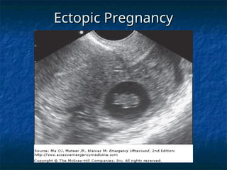 Ectopic Pregnancy
Ectopic Pregnancy
 