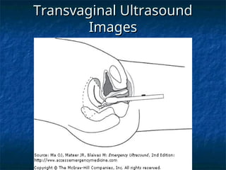 Transvaginal Ultrasound
Transvaginal Ultrasound
Images
Images
 
