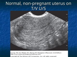 Normal, non-pregnant uterus on
Normal, non-pregnant uterus on
T/V U/S
T/V U/S
 