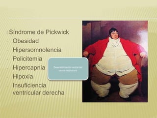 🞭 Síndrome de Pickwick
- Obesidad
- Hipersomnolencia
- Policitemia
- Hipercapnia
- Hipoxia
- Insuficiencia
ventricular derecha
 