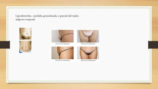 Lipodistrofias : perdida generalizada o parcial del tejido
adiposo corporal
 