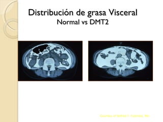Distribución de grasa Visceral
       Normal vs DMT2




   Normal                   DMT2




                   Courtesy of Wilfred Y. Fujimoto, MD.
 