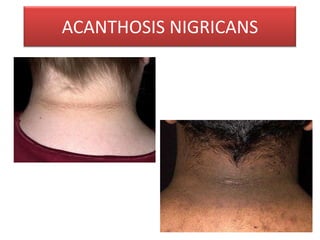ACANTHOSIS NIGRICANS
 