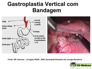 Gastroplastia Vertical com  Bandagem Fonte: DR. Kemmer , cirurgiao HGeR , 2005 .Sociedade Brasileira de cirurgia Bariatrica 
