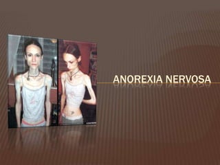 ANOREXIA NERVOSA