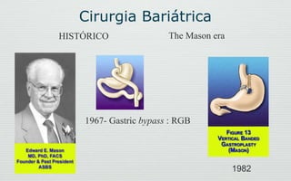 HISTÓRICO The Mason era
1967- Gastric bypass : RGB
1982
Cirurgia Bariátrica
 