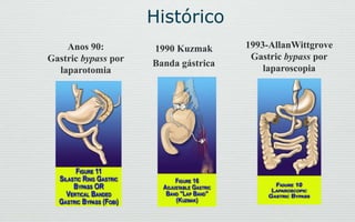 Histórico
Anos 90:
Gastric bypass por
laparotomia
1993-AllanWittgrove
Gastric bypass por
laparoscopia
1990 Kuzmak
Banda gástrica
 