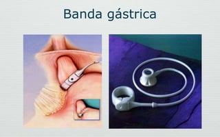 Banda gástrica
 