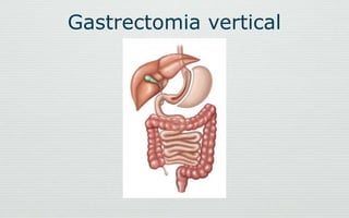 Gastrectomia vertical
 