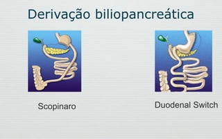 Derivação biliopancreática
Scopinaro Duodenal Switch
 