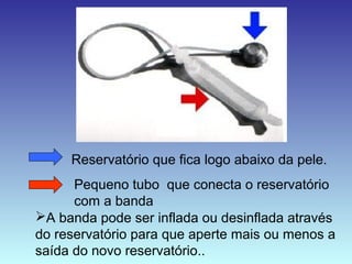 Reservatório que fica logo abaixo da pele.
Pequeno tubo que conecta o reservatório
com a banda
A banda pode ser inflada ou desinflada através
do reservatório para que aperte mais ou menos a
saída do novo reservatório..
 