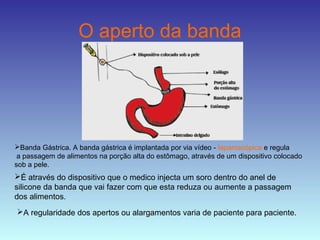 O aperto da banda
Banda Gástrica. A banda gástrica é implantada por via vídeo - laparoscópica e regula
a passagem de alimentos na porção alta do estômago, através de um dispositivo colocado
sob a pele.
É através do dispositivo que o medico injecta um soro dentro do anel de
silicone da banda que vai fazer com que esta reduza ou aumente a passagem
dos alimentos.
A regularidade dos apertos ou alargamentos varia de paciente para paciente.
 