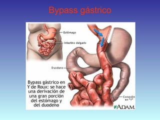 Bypass gástrico
 