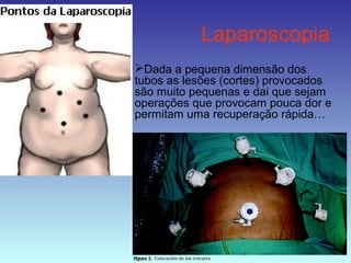 Laparoscopia
Dada a pequena dimensão dos
tubos as lesões (cortes) provocados
são muito pequenas e dai que sejam
operações que provocam pouca dor e
permitam uma recuperação rápida…
 