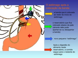 O estômago após a
colocação da banda:
o reservatório que fica
colocado abaixo da pele
(através dele pode
apertar-se ou desapertar
a banda)
a banda que é colocada
ao redor do início do
estômago
novo pequeno “estômago”
Após a digestão do
alimento neste
reservatório, a comida
segue para o restante do
estômago
 