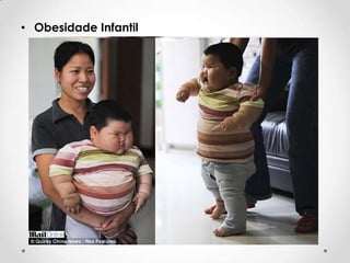 • Obesidade Infantil

 