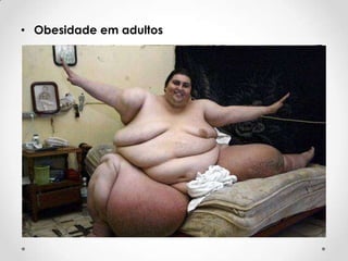 • Obesidade em adultos

 