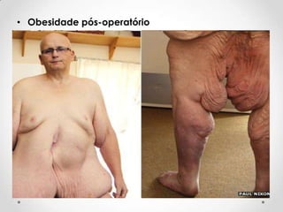 • Obesidade pós-operatório

 