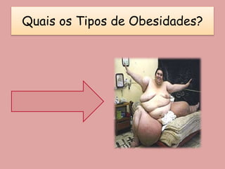 Quais os Tipos de Obesidades?
 