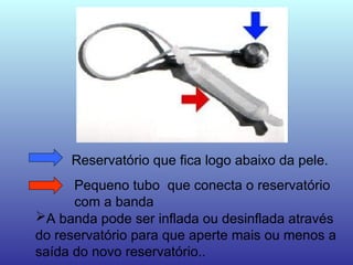 Reservatório que fica logo abaixo da pele.
Pequeno tubo que conecta o reservatório
com a banda
A banda pode ser inflada ou desinflada através
do reservatório para que aperte mais ou menos a
saída do novo reservatório..
 