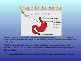 O aperto da banda
Banda Gástrica. A banda gástrica é implantada por via vídeo - laparoscópica e regula
a passagem de alimentos na porção alta do estômago, através de um dispositivo colocado
sob a pele.
É através do dispositivo que o medico injecta um soro dentro do anel de
silicone da banda que vai fazer com que esta reduza ou aumente a passagem
dos alimentos.
A regularidade dos apertos ou alargamentos varia de paciente para paciente.
 
