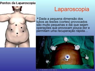 Laparoscopia
Dada a pequena dimensão dos
tubos as lesões (cortes) provocados
são muito pequenas e dai que sejam
operações que provocam pouca dor e
permitam uma recuperação rápida…
 