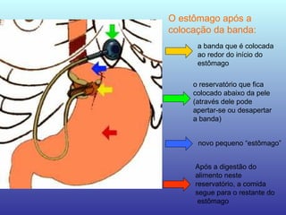 O estômago após a
colocação da banda:
o reservatório que fica
colocado abaixo da pele
(através dele pode
apertar-se ou desapertar
a banda)
a banda que é colocada
ao redor do início do
estômago
novo pequeno “estômago”
Após a digestão do
alimento neste
reservatório, a comida
segue para o restante do
estômago
 