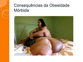 Consequências da Obesidade
Mórbida
 