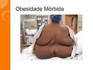 Obesidade Mórbida
 