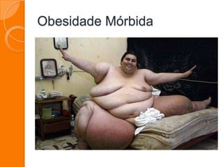 Obesidade Mórbida
 