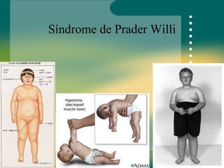 Síndrome de Prader Willi 