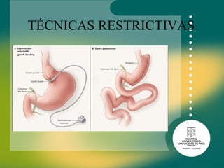 TÉCNICAS RESTRICTIVAS 
