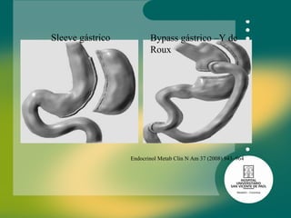Bypass gástrico –Y de Roux Sleeve gástrico Endocrinol Metab Clin N Am 37 (2008) 943–964 