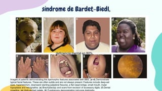 OBESIDAD INFANTIL.pptx