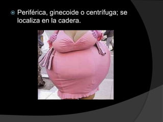    Periférica, ginecoide o centrífuga; se
    localiza en la cadera.
 