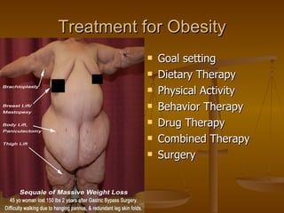 Treatment for Obesity Goal setting Dietary Therapy Physical Activity Behavior Therapy Drug Therapy Combined Therapy Surgery 