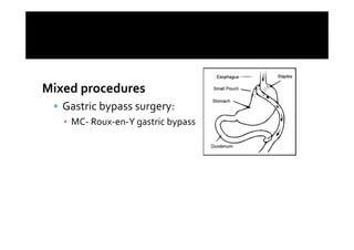 Mixed procedures
   Gastric bypass surgery:
   ▪ MC- Roux-en-Y gastric bypass
 