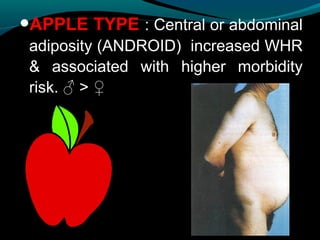 •APPLE TYPE : Central or abdominal
adiposity (ANDROID) increased WHR
& associated with higher morbidity
risk. ♂ > ♀
 