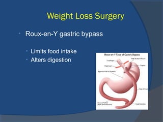 Weight Loss Surgery
• Roux-en-Y gastric bypass
• Limits food intake
• Alters digestion
 