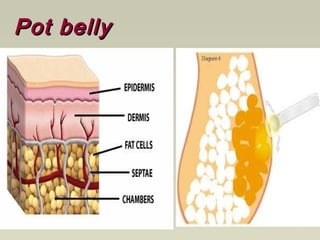Pot bellyPot belly
 