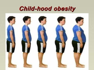 Child-hood obesityChild-hood obesity
 
