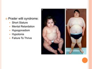  Prader willi syndrome:
 Short Stature
 Mental Retardation
 Hypogonadism
 Hypotonia
 Failure To Thrive
 