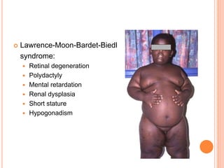  Lawrence-Moon-Bardet-Biedl
syndrome:
 Retinal degeneration
 Polydactyly
 Mental retardation
 Renal dysplasia
 Short stature
 Hypogonadism
 