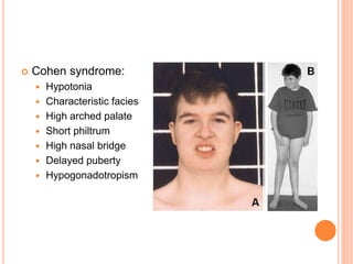  Cohen syndrome:
 Hypotonia
 Characteristic facies
 High arched palate
 Short philtrum
 High nasal bridge
 Delayed puberty
 Hypogonadotropism
 