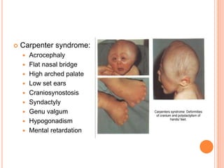 Carpenter syndrome:
 Acrocephaly
 Flat nasal bridge
 High arched palate
 Low set ears
 Craniosynostosis
 Syndactyly
 Genu valgum
 Hypogonadism
 Mental retardation
 